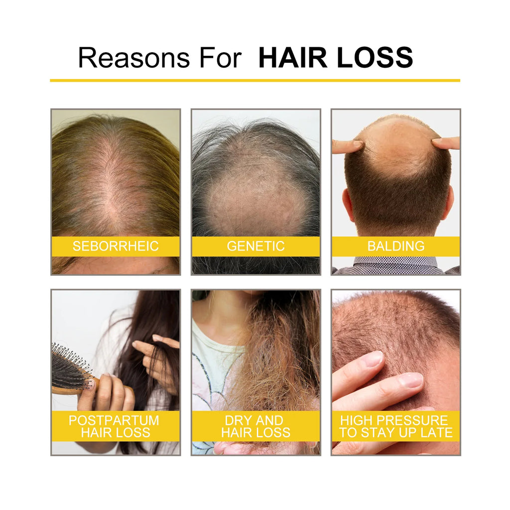 Hair Growth Essential Oil Treatment Seborrheic Alopecia Follicle Repairing Reduce Hairline Baldness Dense Growing Hairs Lotion - AliExpress 66
