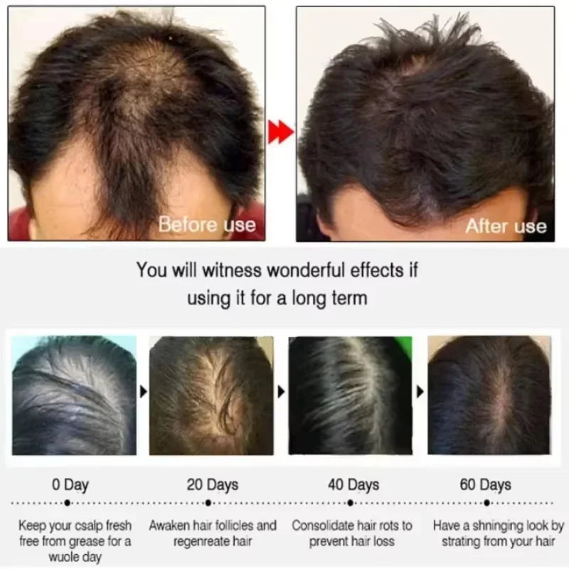 Fast Hair Growth Serum Spray Anti Hair Loss Prevent Baldness Scalp Treatment Repair Roots Beauty Health Hair Care For Men Women